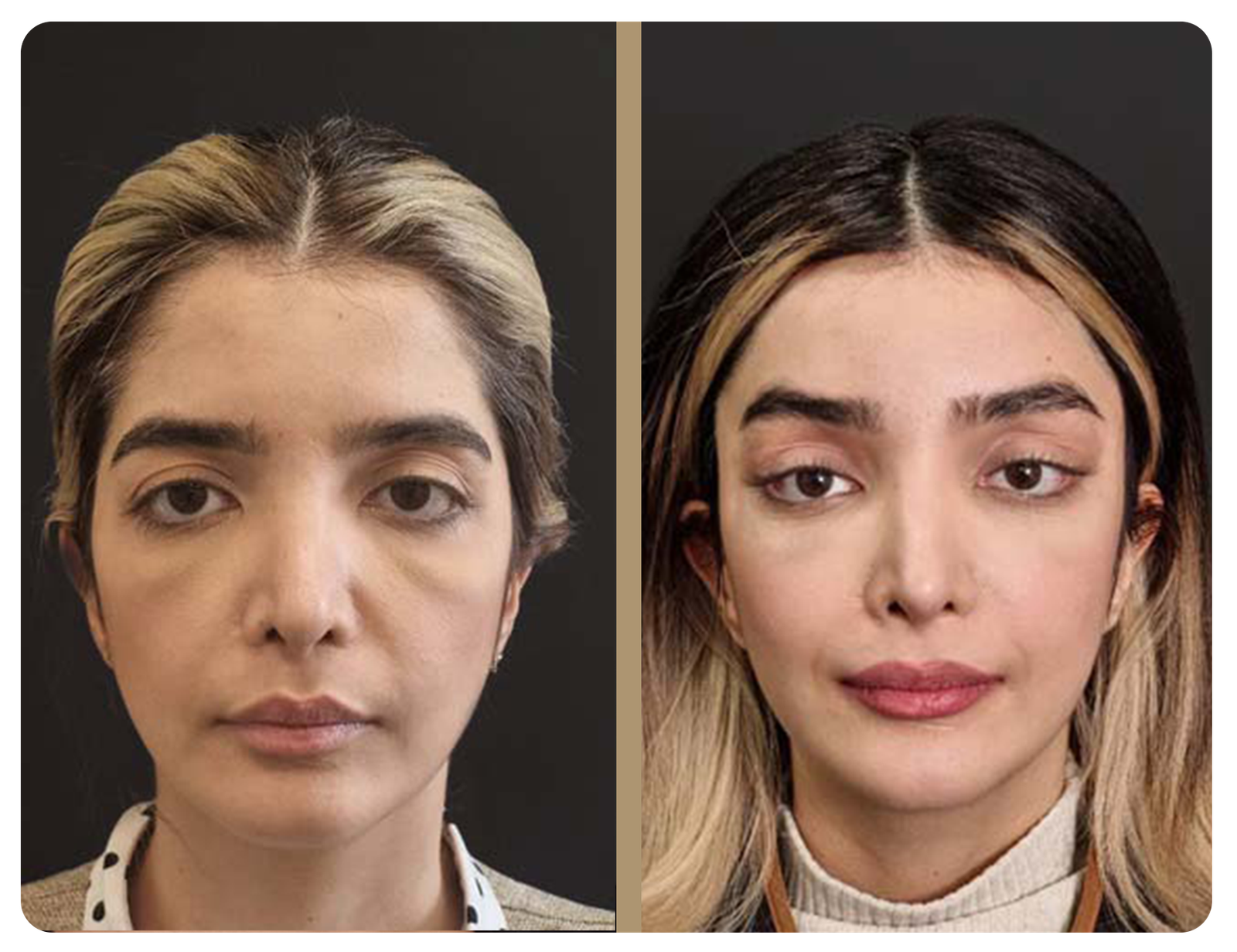 Before and After