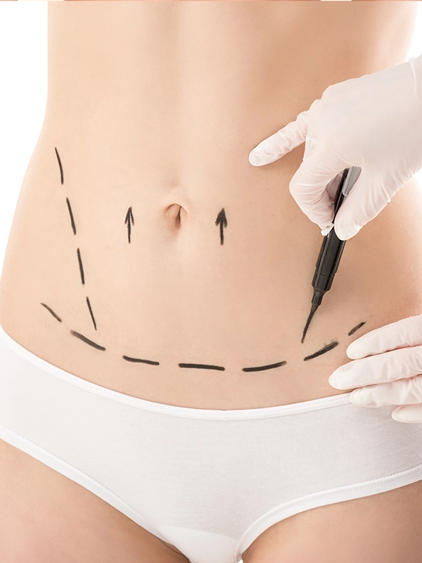 Abdominoplasty (Tummy Tuck)