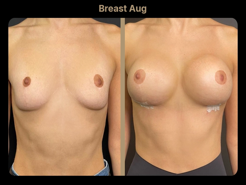 Before and After