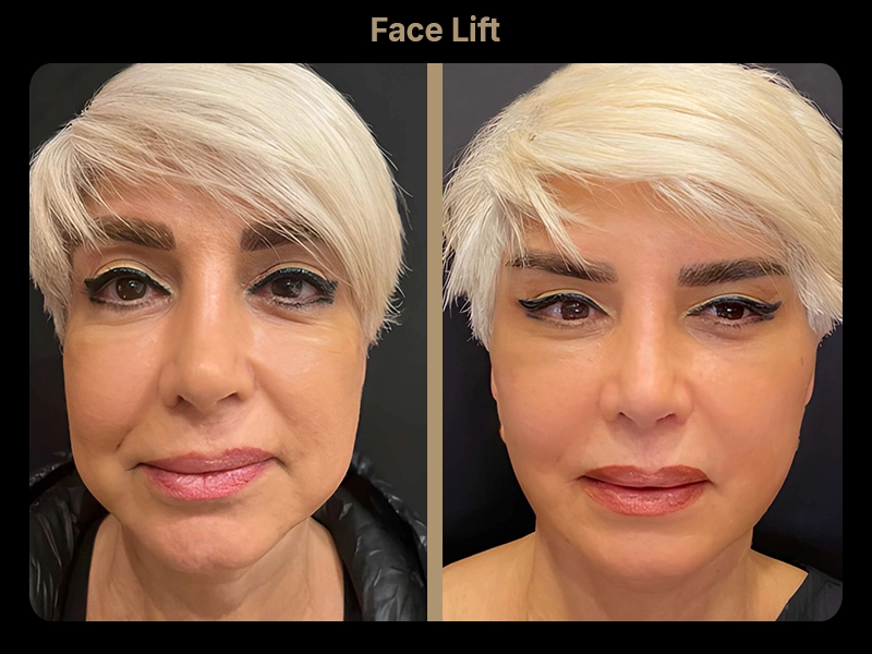 Before and After