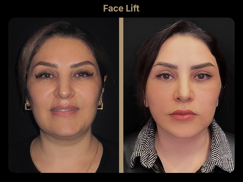 Before and After