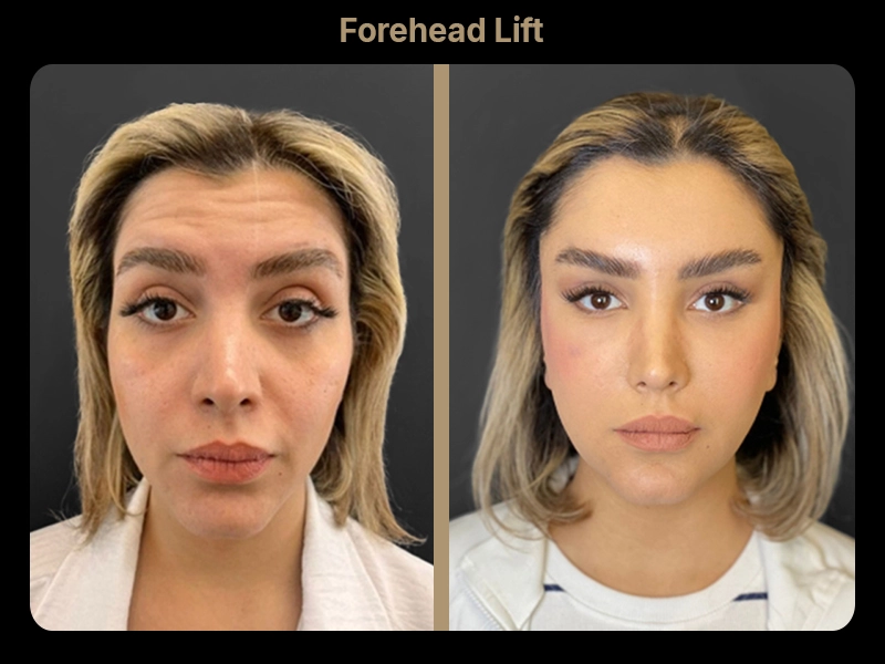 Before and After