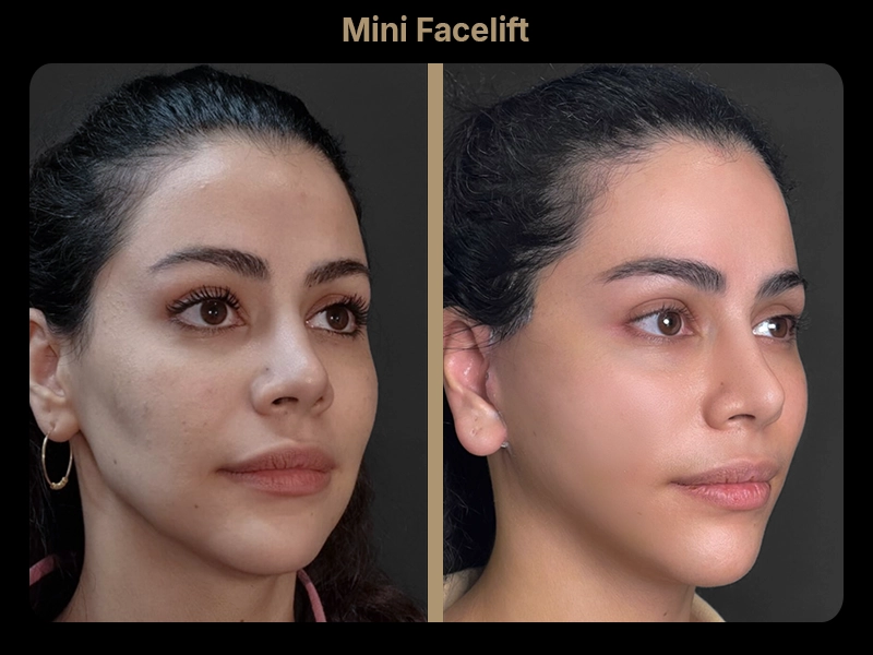 Before and After